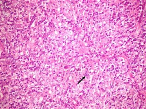 Pathology Outlines T Cell Histiocyte Rich Diffuse Large B Cell Lymphoma