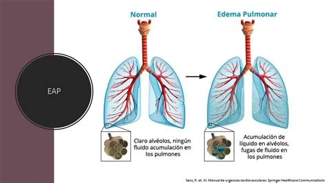 Edema agudo pulmonar Clasificación YouTube