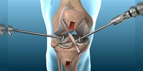 Artroscopía Traumatología Roca