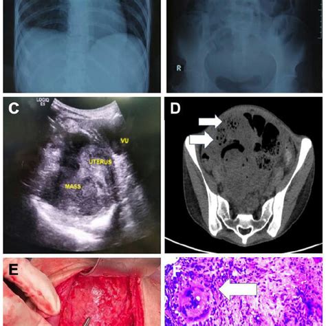 Chest x-ray and abdominal x-ray revealed normal results (A and B ...