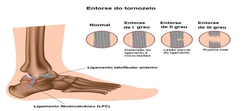 Portf Lio Andressa Baron Fisioterapia Orto Entorse Do Tornozelo