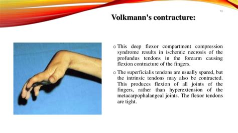 Claw Hand,Definition,Causes,Types,Symptoms and Management