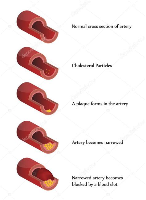 Ector Atherosclerosis Illustration Stock Vector Megija