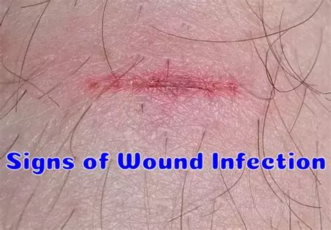 7 Signs of Wound Infection and What to Do - Health Advisor