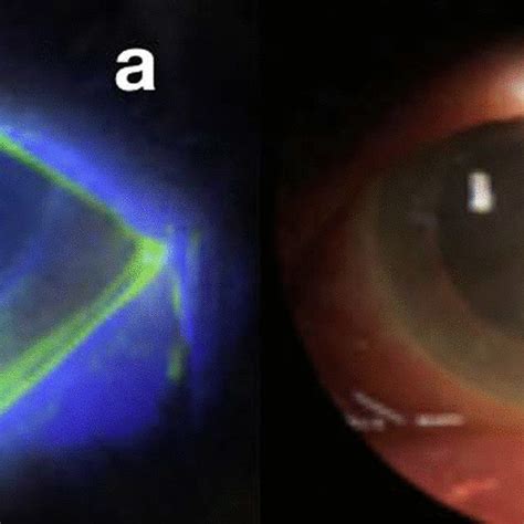 A Central And Inferior Positive Fluorescein Keratitis Of Dendritic Download Scientific Diagram