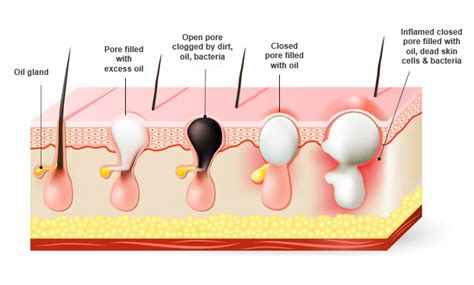 The Complete Guide - Fixing Hormonal Chin Acne Naturally