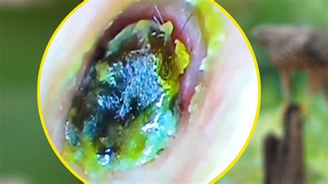 Totally Blocked Ear Wax Removal YouTube