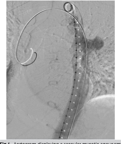 Figure 4 From Treatment Of A Descending Thoracic Mycotic Aneurysm