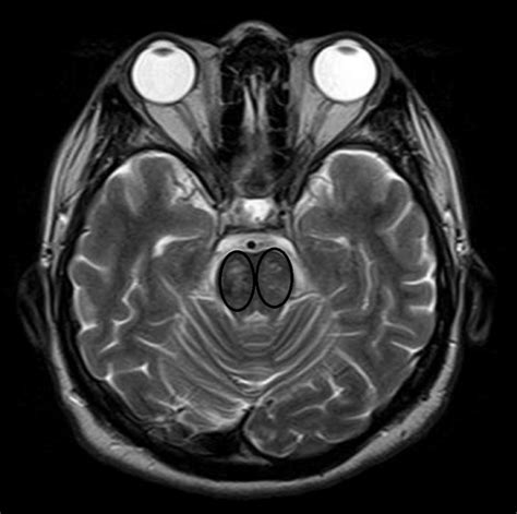 T2 FLAIR Axial MR Image Showing Hyperintense Lesion Over Bilateral Pons