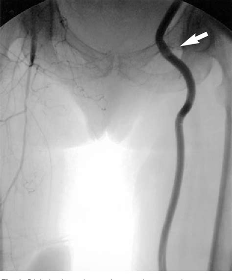 Figure 3 From Management Of Vascular Infection In The Groin Semantic Scholar