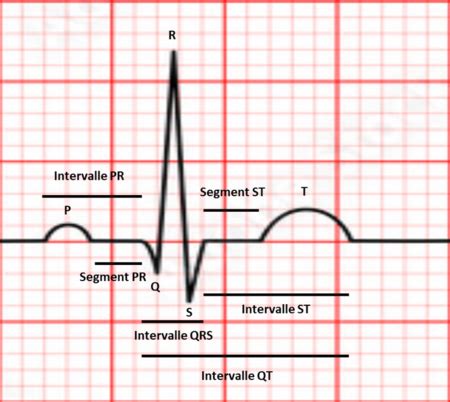 Segment Pr Ou Segment Pq Uness Wiki Ecg