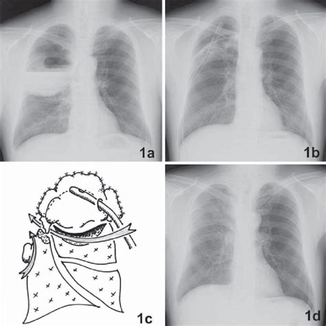 A Chest X Ray On Admission Showing An Infected Giant Bulla 17 Cm In