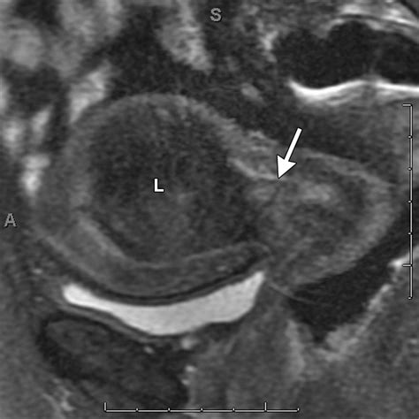 Role Of Mr Imaging Of Uterine Leiomyomas Before And After Embolization