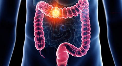 Todo Sobre El C Ncer De Colon Causas S Ntomas Y Tratamiento