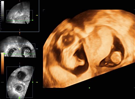 Triplets 3d Ultrasound