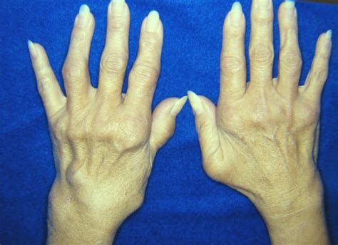 Rheumatoid Arthritis - Virginia Hand Center