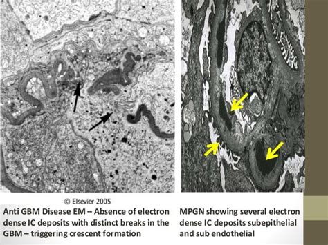 Approach to Rapidly Progressive Glomerulonephritis RPGN