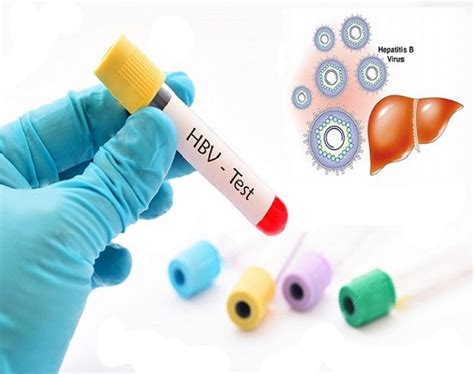 Xét nghiệm Định lượng Virus Viêm gan B HBV DNA