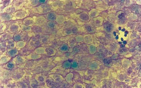 Cytology Of Left Ear Smear Of Case 1 Showing Malassezia Yeasts With Download Scientific Diagram