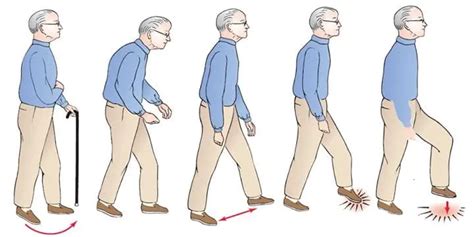 Parkinsonian Gait - Cause, Treatment, Gait Training Exercise