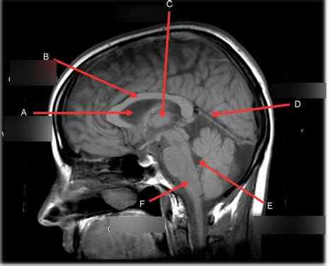 Mri Brain anatomy Diagram | Quizlet