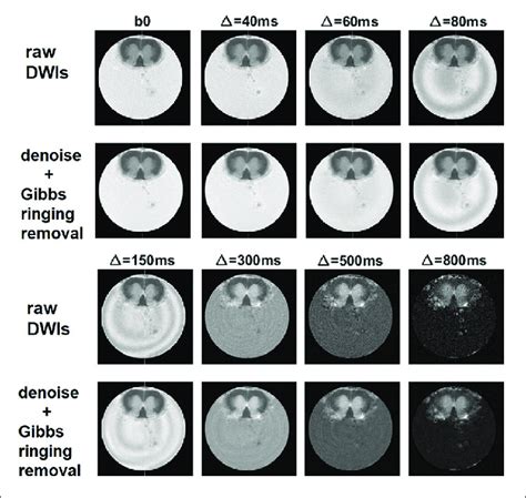 Denoising And Removal Of Gibbs Ringing Artifact In Dwi Used To Obtain