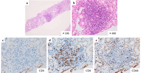 Hematoxylin And Eosin Staining Showed Focal Interstitial Inflammatory Download Scientific