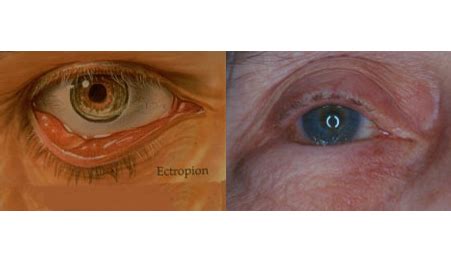 Eyelid Ectropion Surgery Denver | Eyelid Entropion Surgery Boulder