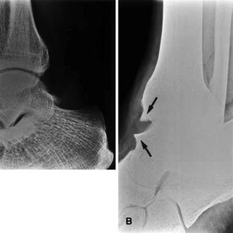 Two Radiographs Of The Same Patient With Anteromedial Ankle Impingement