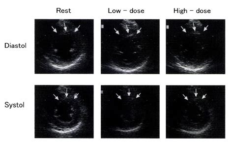 Figure From Clinical Usefulness And Safety Of Dobutamine Stress