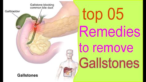 Top 05 Remedies To Remove Gallstones Exclusively Youtube