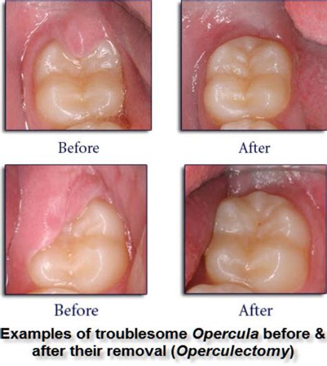 operculectomy pic – Dental Health Stop