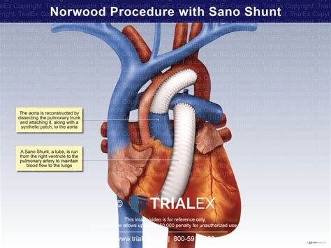 norwood procedure  sano shunt trialquest