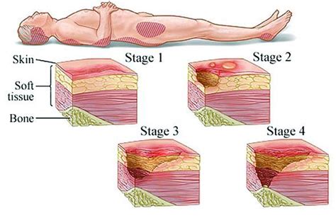 Decubitus Pressure Ulcer Pressure Ulcer Staging Soreness