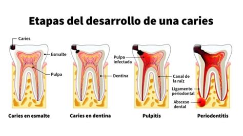 Caries Dentales Causas Tipos Y Tratamientos Según Su Avance Dental