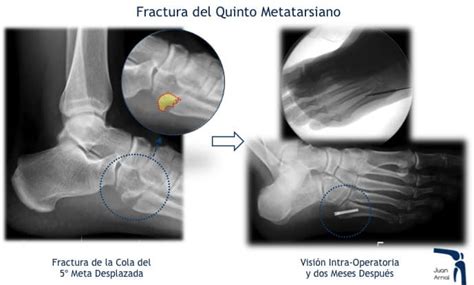 Fracturas De Pie Y Tobillo En El Deporte Juan Arnal Traumatologo En