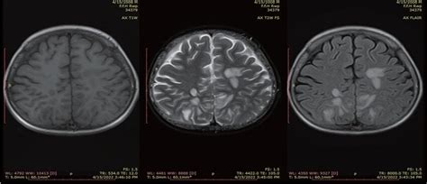 Axial T Wi T Wi And Flair Sequence Showing Areas Of T And Flair