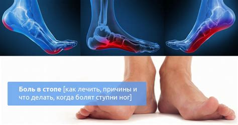 Почему болят пятки на ногах: причины и способы лечения