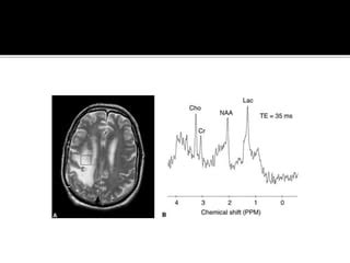 MR spectroscopy | PPT