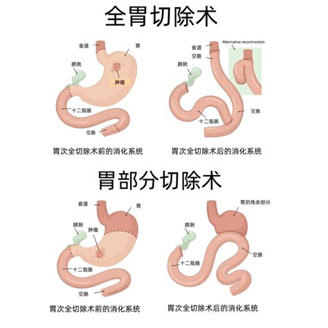 胃癌治疗 胃肿瘤切除 新加坡肠胃专科医生