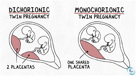 The Difference Between Dichorionic And Monochorionic Twins Ucsf