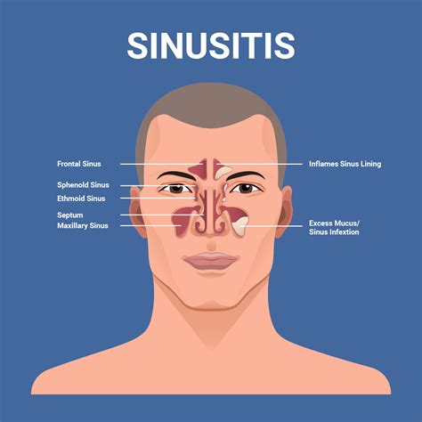 Sinusitis Pictures