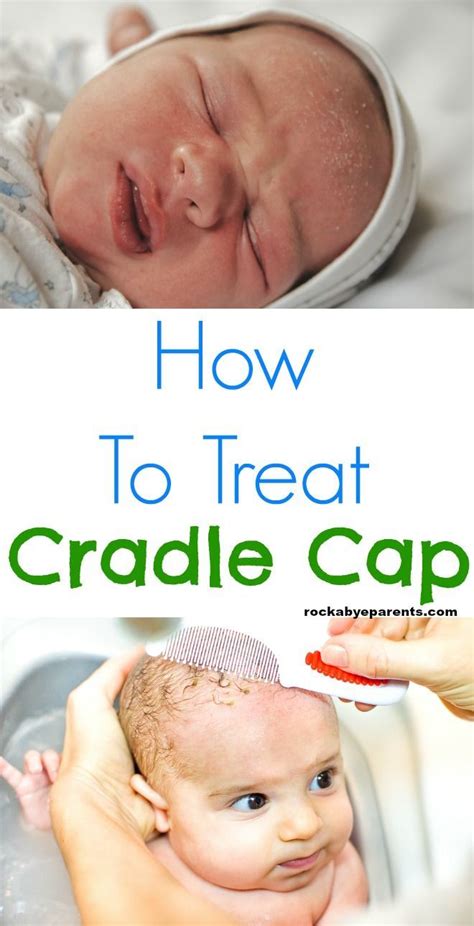 How To Get Rid Of Cradle Cap 6 Different Treatments To Try Cradle