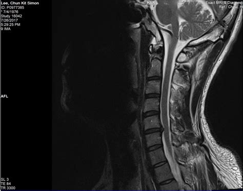 Cervical Disc Disorder