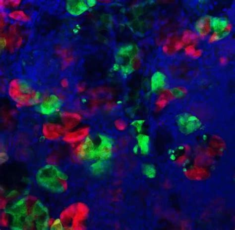 Uncovering How Injury To The Pancreas Impacts Cancer Formation