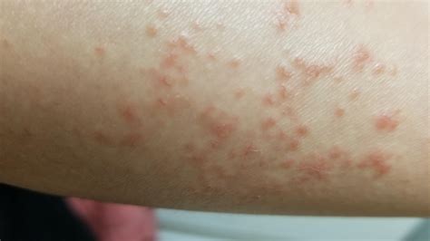 HELPp! I have this red bumpy acne rash on my forearm that sting when ...