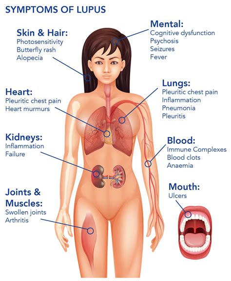 An Alternative Standard Of Care For Severe Lupus Disease