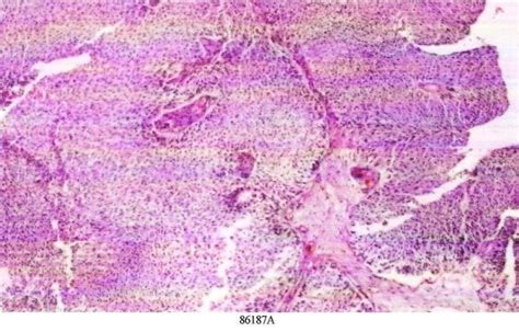 Histological Features Of Transitional Cell Carcinoma Download Scientific Diagram