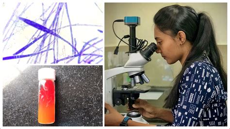 All you need to know about diagnosis of dermatophytosis | clinical ...