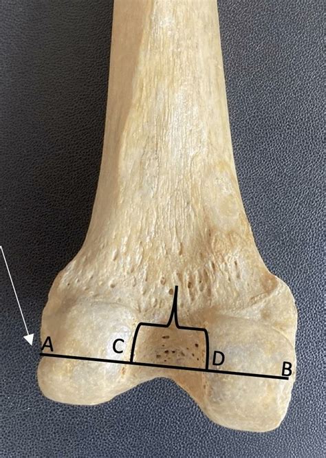 Shows The Measurements Of The Bicondylar And Intercondylar Notch Width